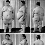 Características de la obesidad hipotalámica, signos y tratamiento.