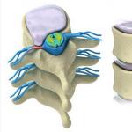 Intervertebral disk hernia: symptoms, treatment
